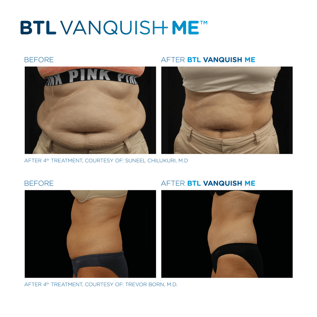 Achieve your fitness goals with advanced EmSculpt NEO treatments in Westerville, Ohio. Free trials available now!
