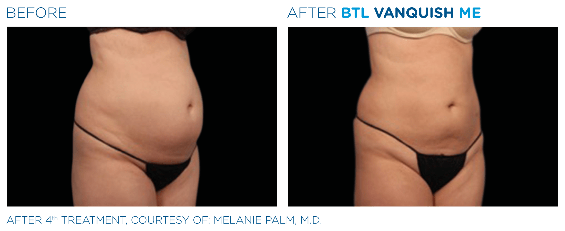 Discover the benefits of EmSculpt and EmSculpt NEO at Wrinkle and Weight in Westerville, OH. Get started today!