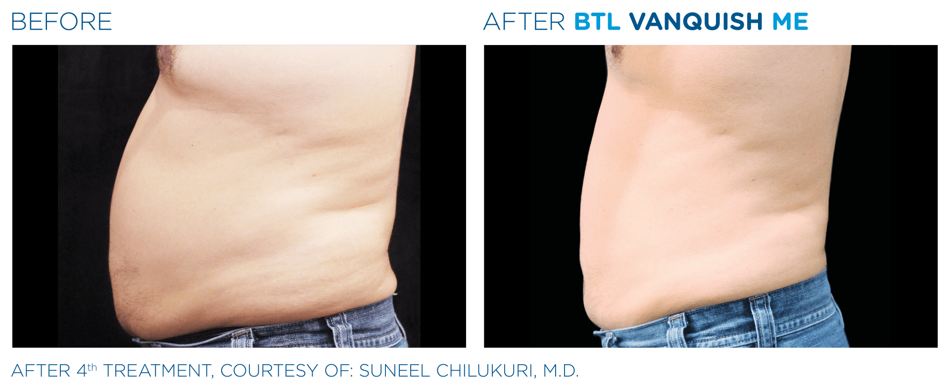 Vanquish ME results on the abdomen