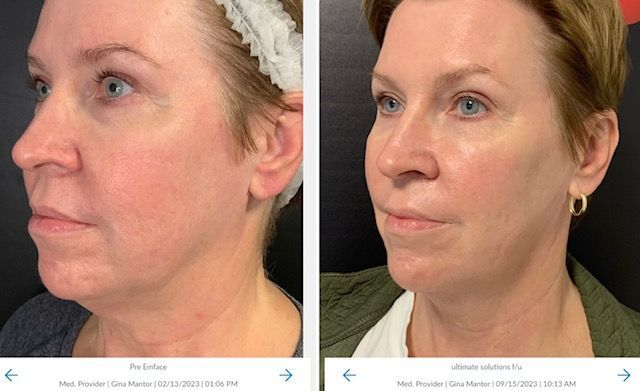 EMFACE™ dual tech device targets wrinkles and facial volume, improving skin and muscle health effectively.