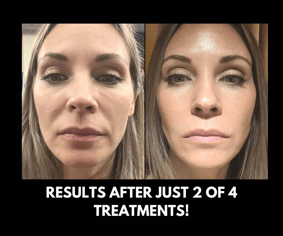 Achieve a youthful, lifted appearance with EMFACE™ – a needle-free solution for enhanced skin tone and volume.