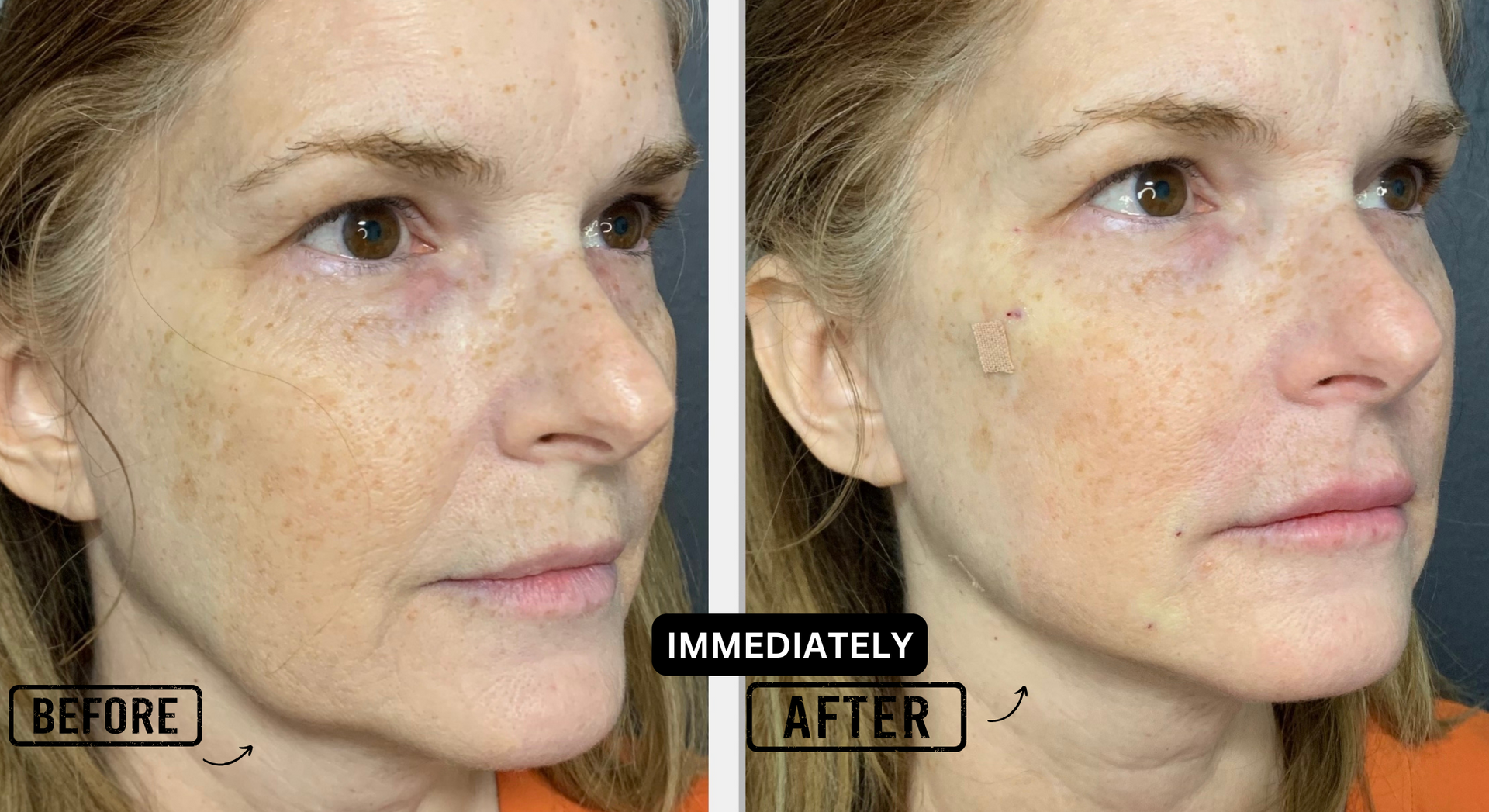 Thread lift results  preformed by Double-Board certified Physician, Dr. Gina Mantor in Westerville, OH