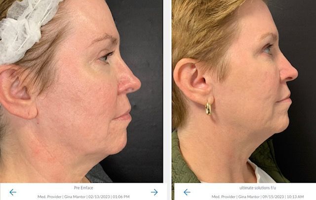 EMFACE™ dual tech device targets wrinkles and facial volume, improving skin and muscle health effectively.