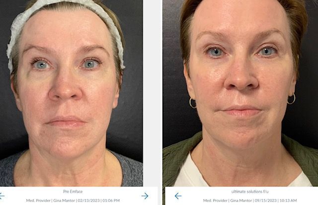 Advanced EMFACE™ technology combines skin and muscle care for reduced wrinkles and enhanced facial volume.