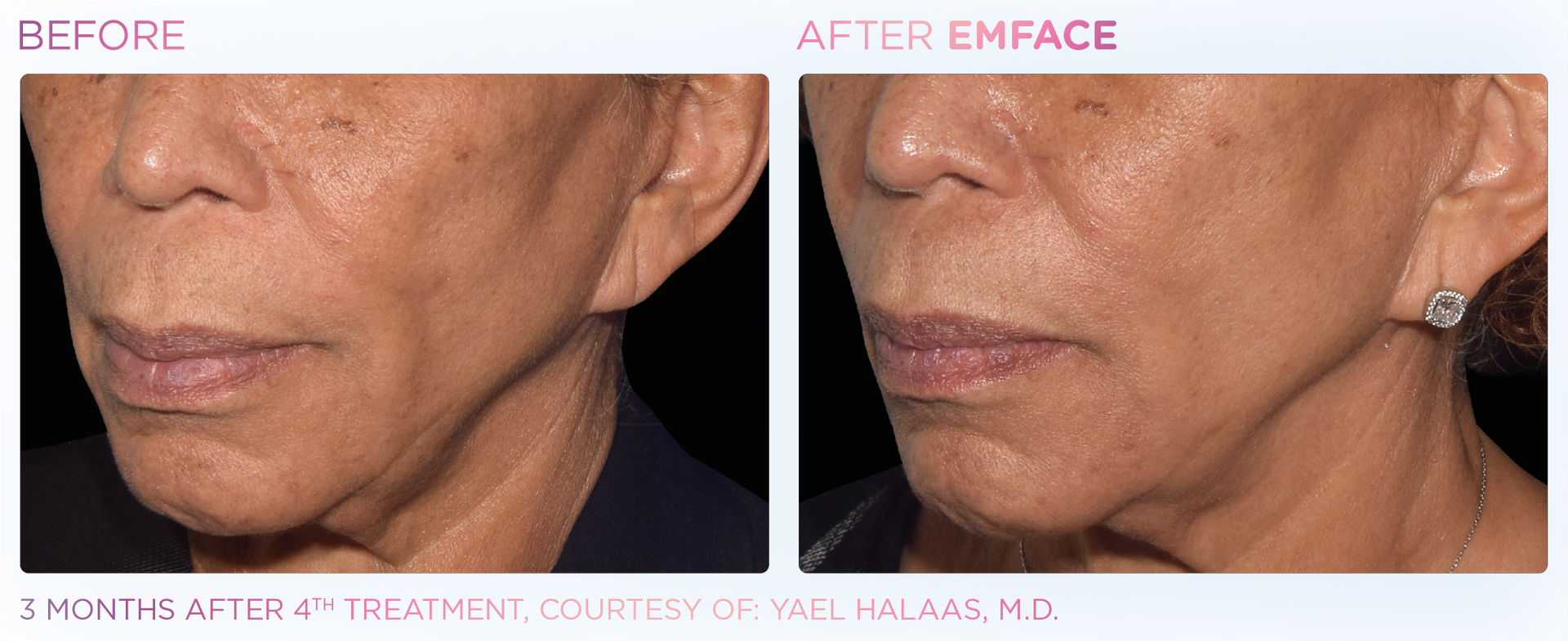 Achieve a refreshed complexion with Emface's gentle RF and HIFES energy, reducing wrinkles for a youthful look.