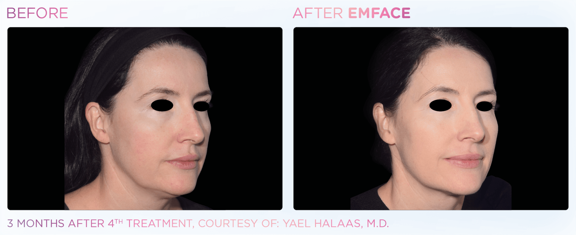 Achieve a refreshed, contoured complexion with Emface, the revolutionary facial toning treatment for men and women.