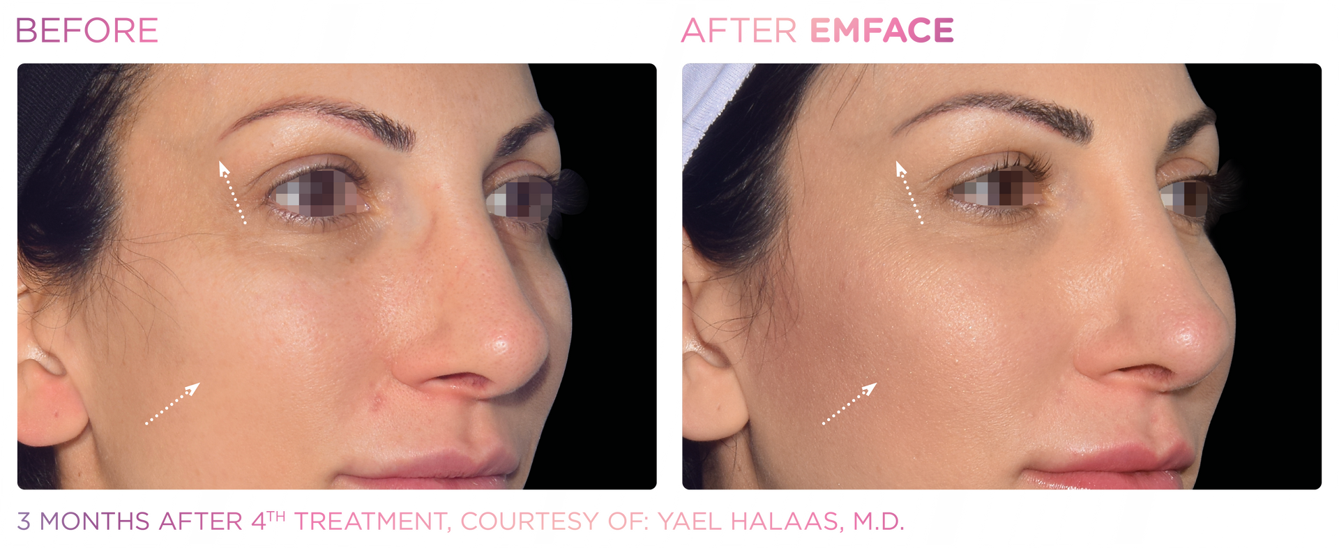 Achieve a refreshed, contoured complexion with Emface, the revolutionary facial toning treatment for men and women.