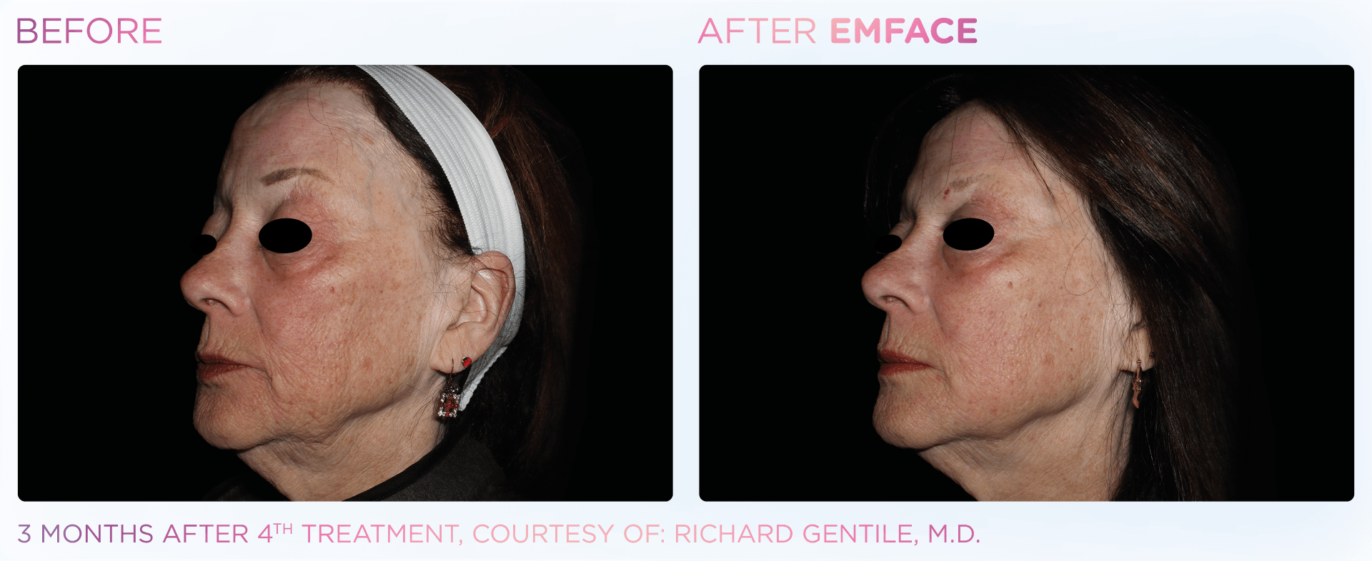 Emface is a game-changer for facial contouring—no needles, no surgery, just a youthful look.