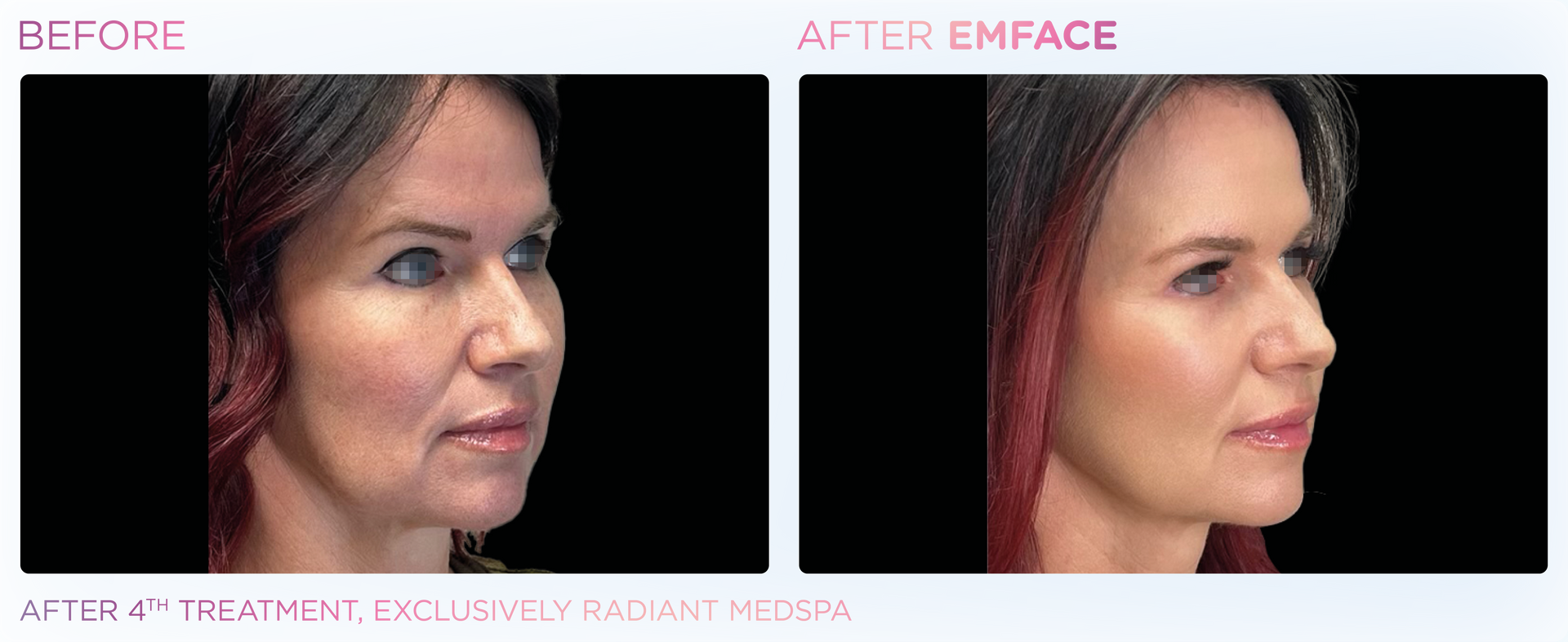 Emface's gentle procedure enhances natural beauty, offering men and women a refreshed complexion without surgery.