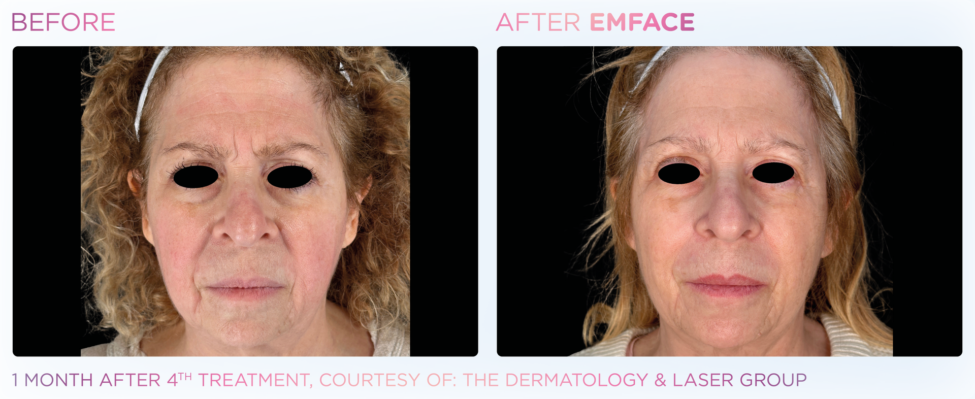 Achieve a refreshed look with Emface, the non-invasive procedure with no downtime for men and women.