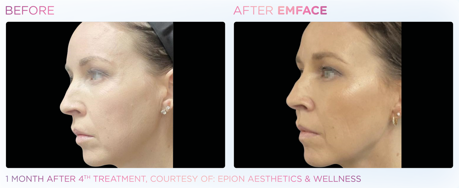 EMFACE™ delivers a non-invasive facial lift, improving skin tone and volume with no downtime or harmful chemicals.