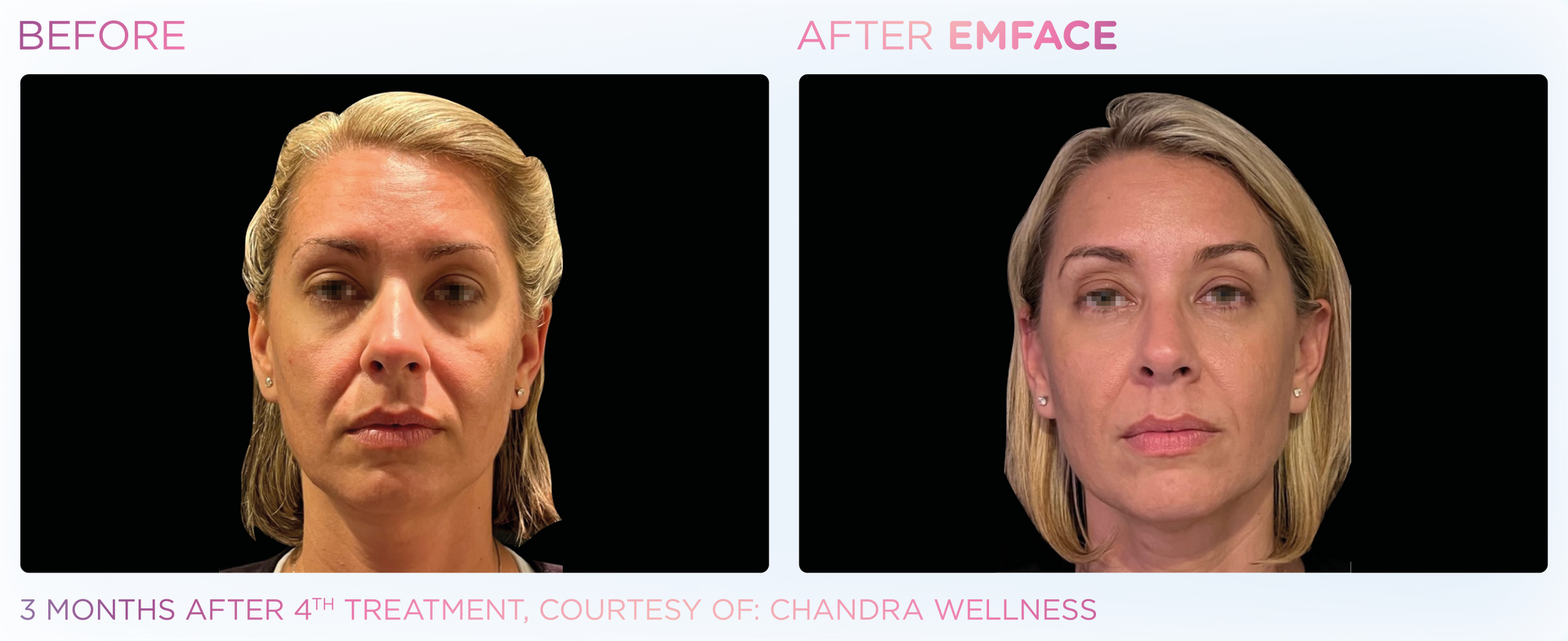 EMFACE™ offers a non-invasive facial lift, improving skin tone and volume without needles, downtime, or toxins.