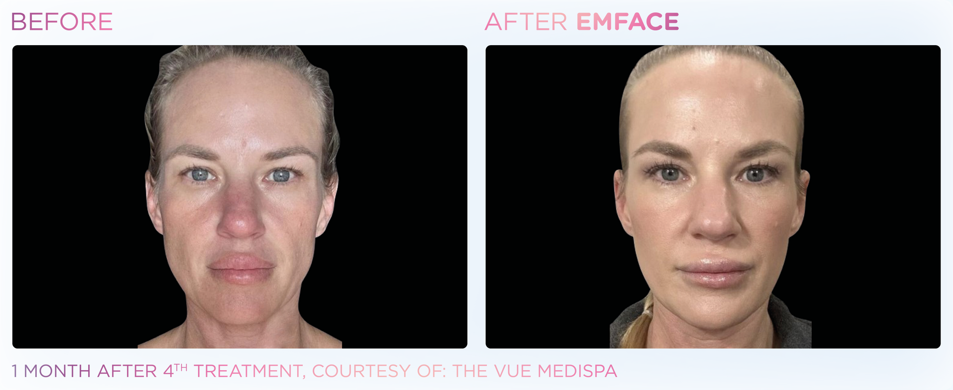 EMFACE™ delivers a toxin-free, non-surgical facial lift, boosting skin tone and volume with zero recovery time.