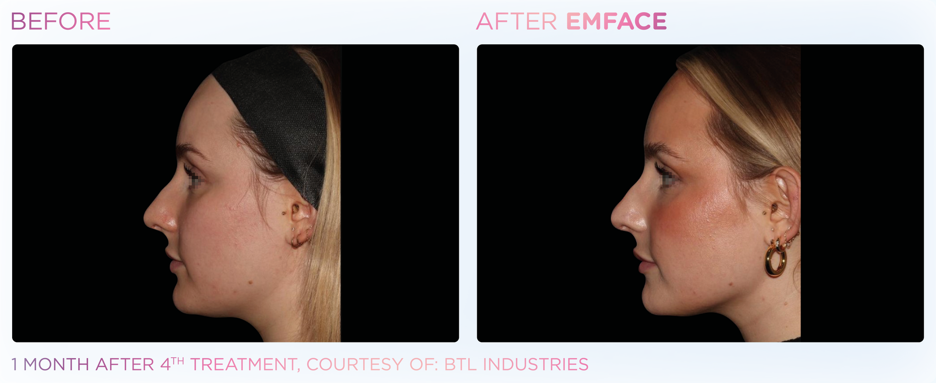 EMFACE™ offers a needle-free facial lift, enhancing skin tone and volume without downtime or toxins.