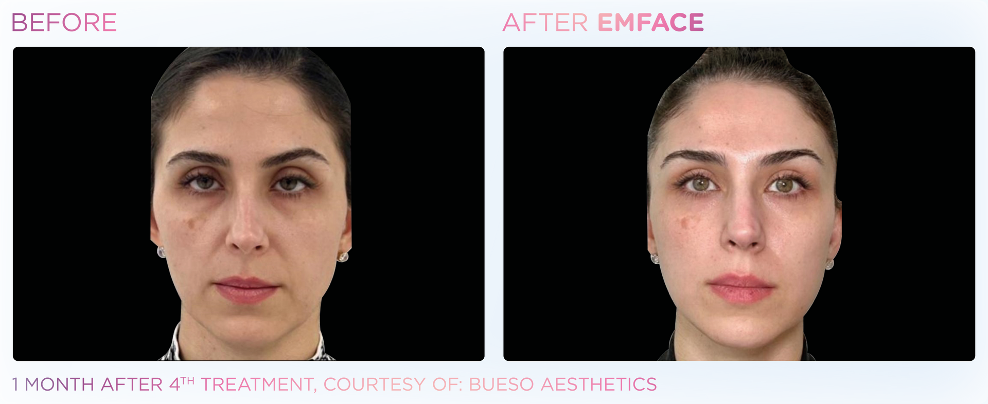 EMFACE™ uses Synchronized Radio Frequency and HIFES to remodel skin, tone muscles, and lift the face.