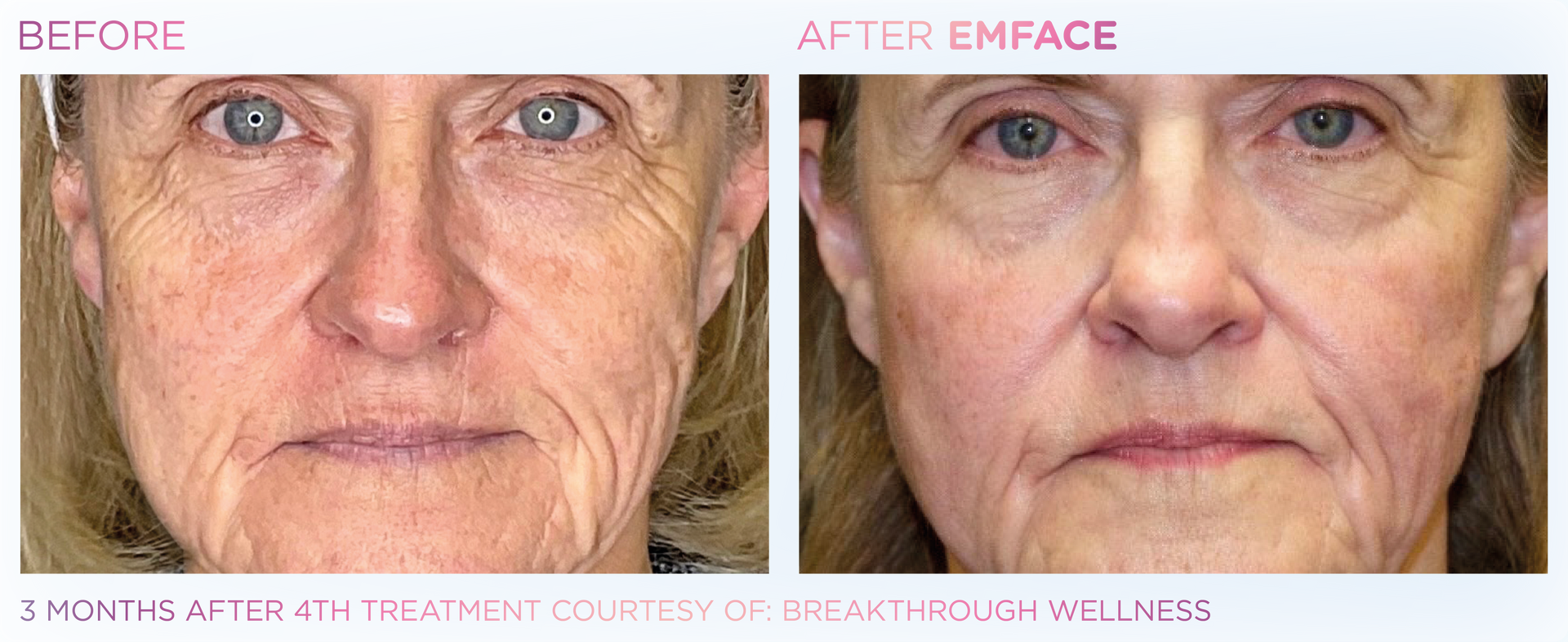 EMFACE™ offers a safe, non-toxic facial lift solution that boosts volume and tone with zero recovery time.