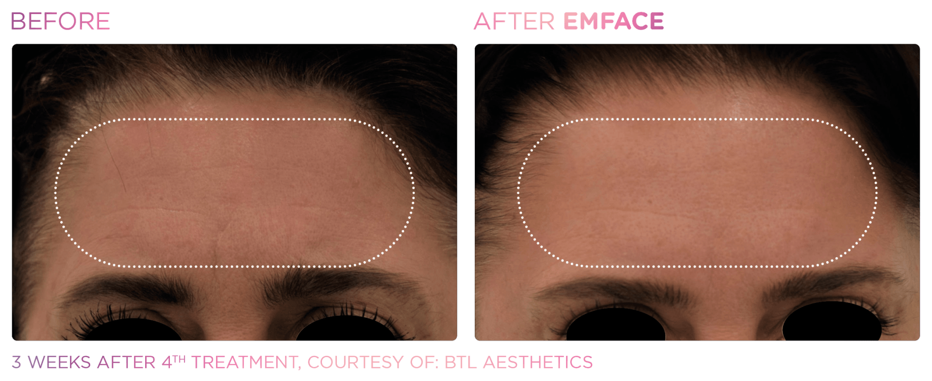 Get a youthful look with Emface—no needles, no surgery, no downtime. Just a refreshed, contoured face.