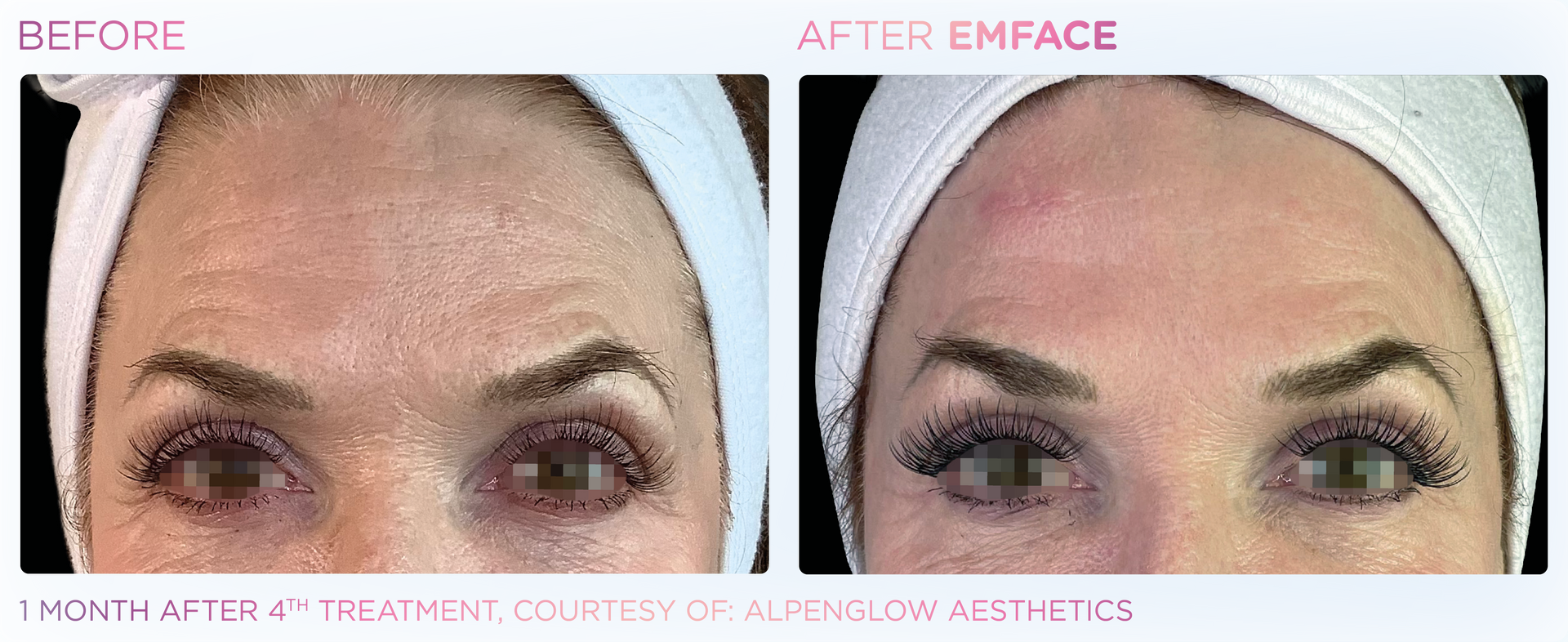 Transform your skin and muscle care routine with EMFACE™. Say goodbye to wrinkles and hello to volume!