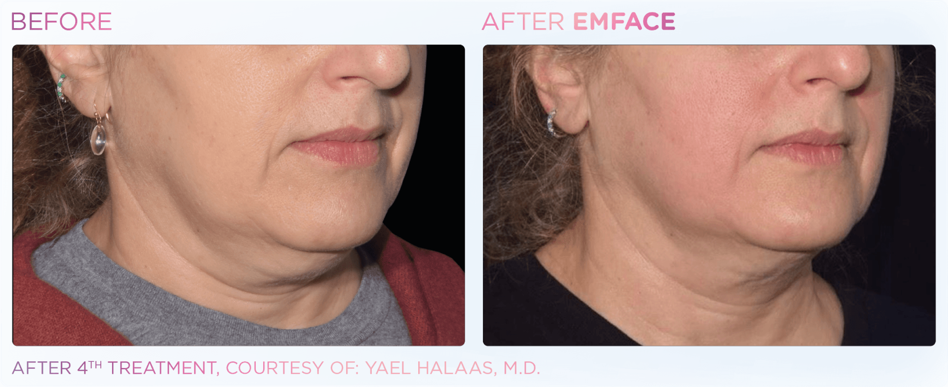 EMFACE™ uses Radio Frequency and HIFES to remodel skin, tone muscles, and lift the face without needles or downtime.