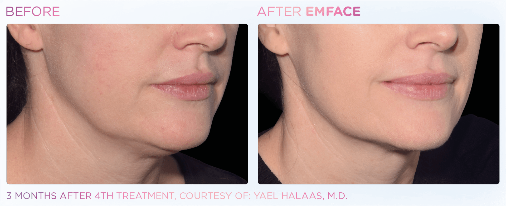 Achieve a tighter jaw line and reduce wrinkles with EMFACE™ dual technology for skin and muscle rejuvenation.