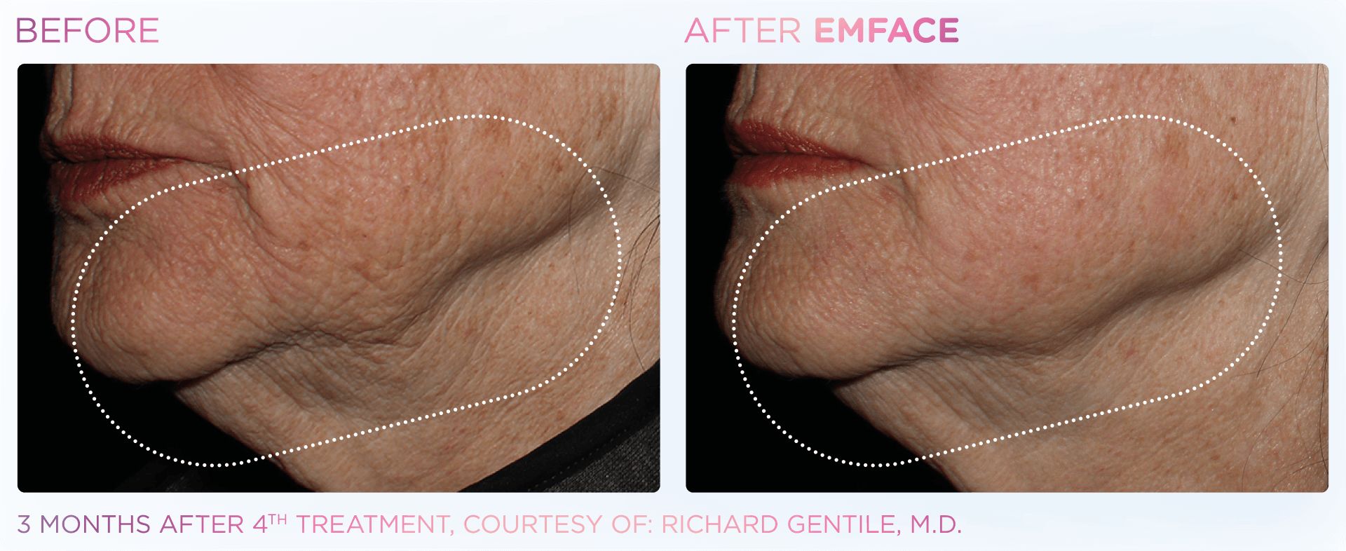 EMFACE™ dual tech for enhanced wrinkle reduction, facial volume boost, and jaw line tightening in one device.