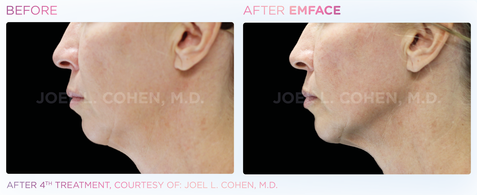 Emface offers a revolutionary needleless, non-surgical solution for facial contouring, toning, and lifting.