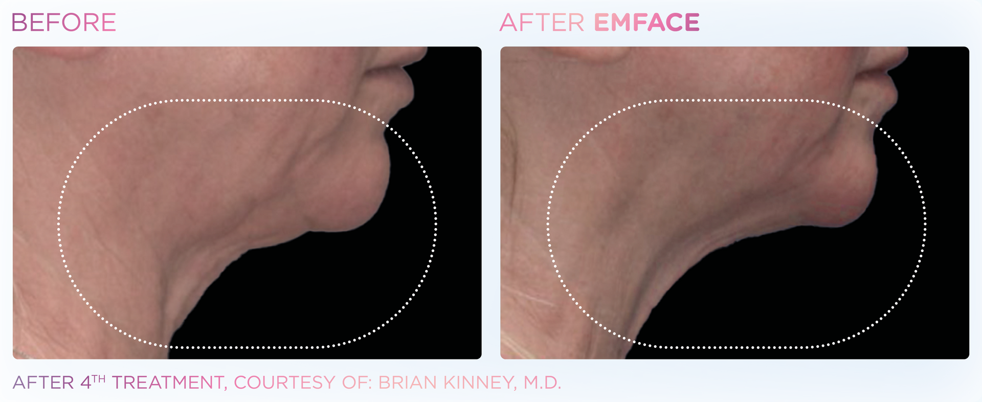 Experience Emface's non-surgical facial contouring to tone, lift, and refresh your complexion with zero downtime.