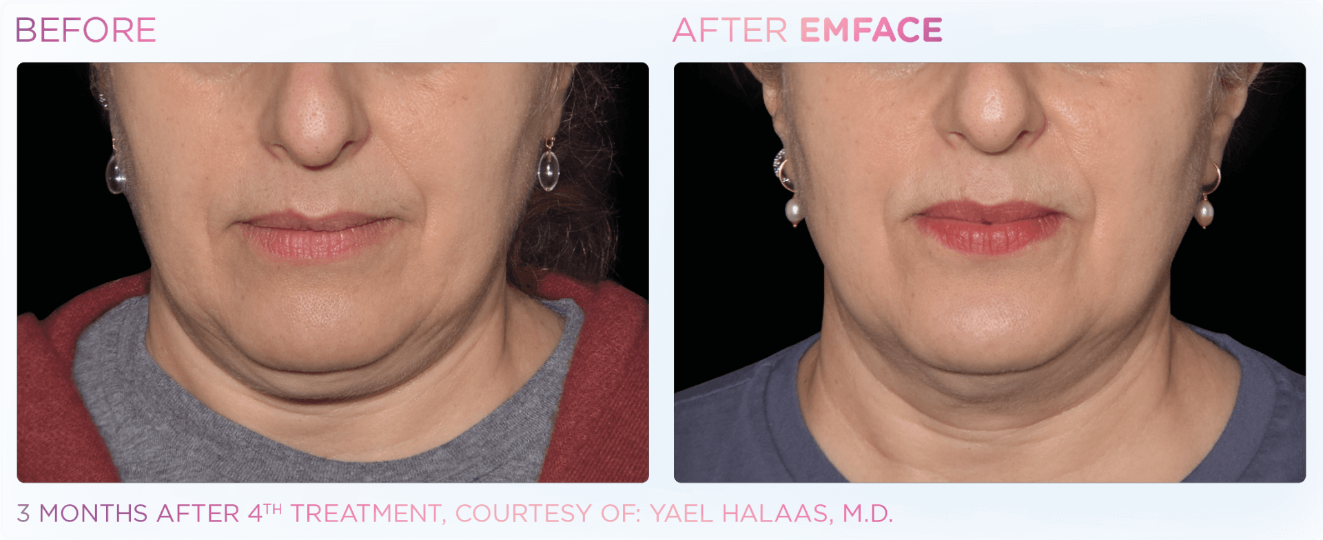 EMFACE™ dual tech device for enhanced wrinkle reduction and facial volume, combining skin and muscle care.