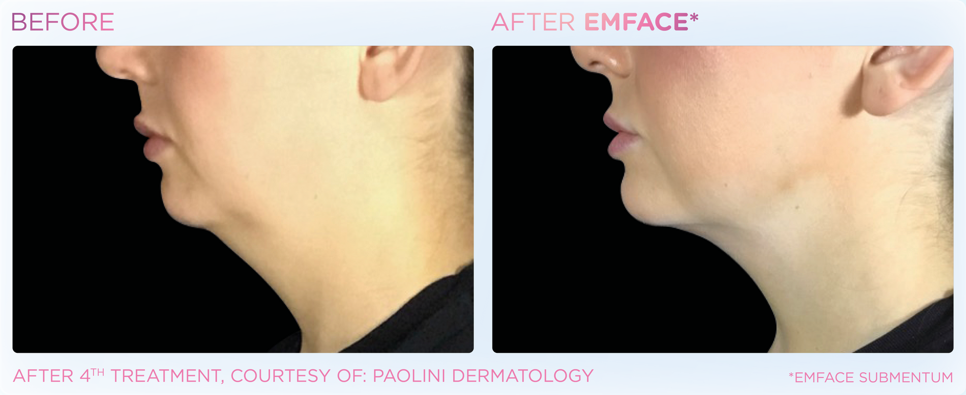 reduce your double chin with emface at Dr. Mantor's Wrinkle and Weight Solutions