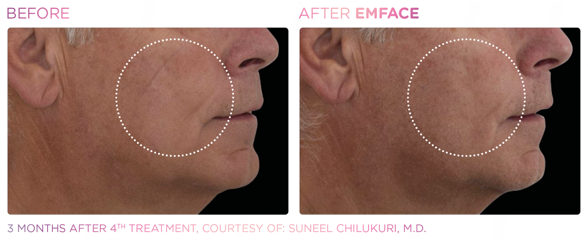 Experience the future of facial contouring with Emface, enhancing beauty and reducing wrinkles without surgery.