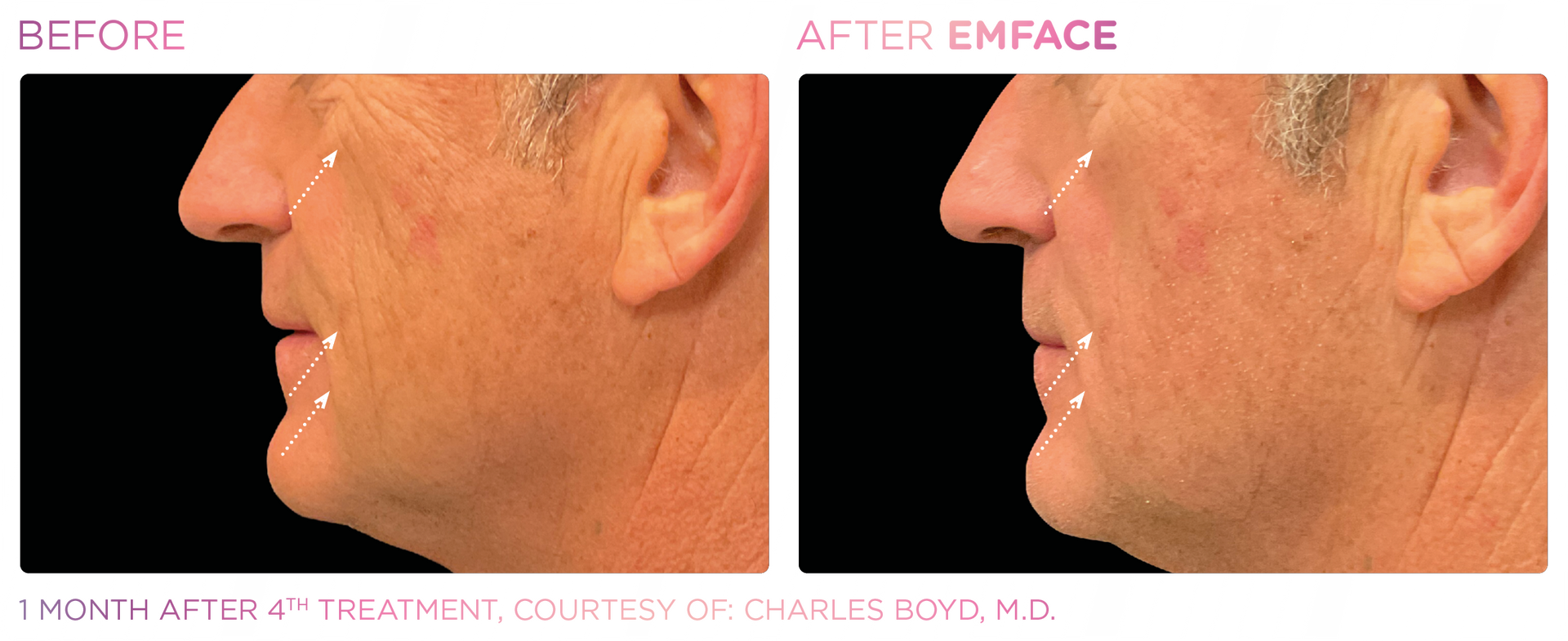 Revolutionize your beauty routine with Emface. Tone, lift, and refresh your face effortlessly without needles.