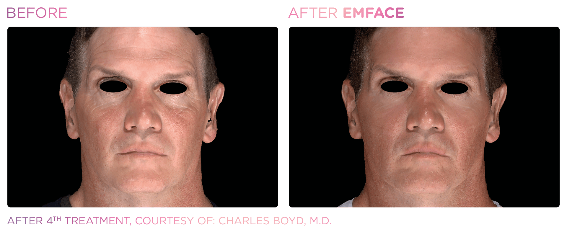 EMFACE™ dual tech device reduces wrinkles and enhances facial volume for both men and women.