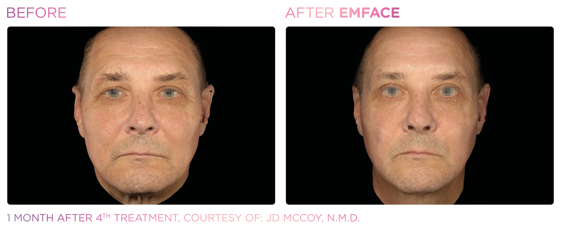 Emface offers a needleless, non-surgical solution to tone, lift, and rejuvenate your face with no downtime.