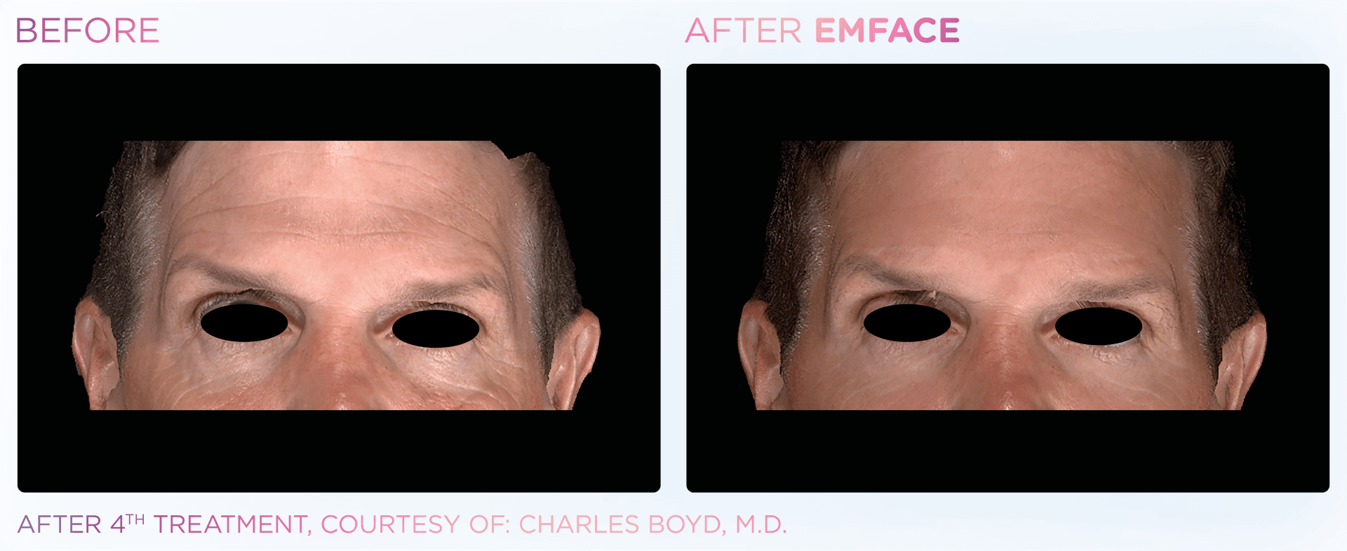 Men and women enjoy Emface's facial contouring benefits without intense recovery or downtime.
