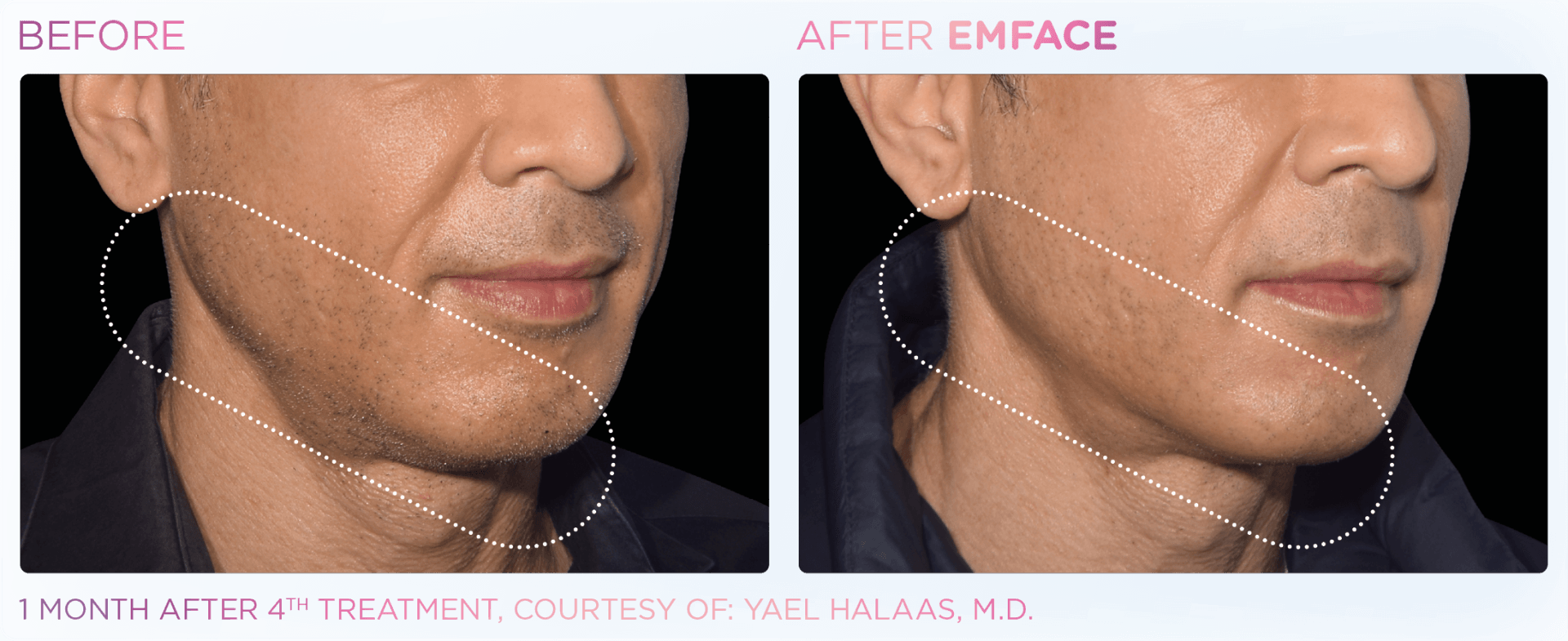EMFACE - Remodels and Smoothens Your Skin Using Synchronized RF and HIFES Technologies Without Needles, Toxins or Fillers