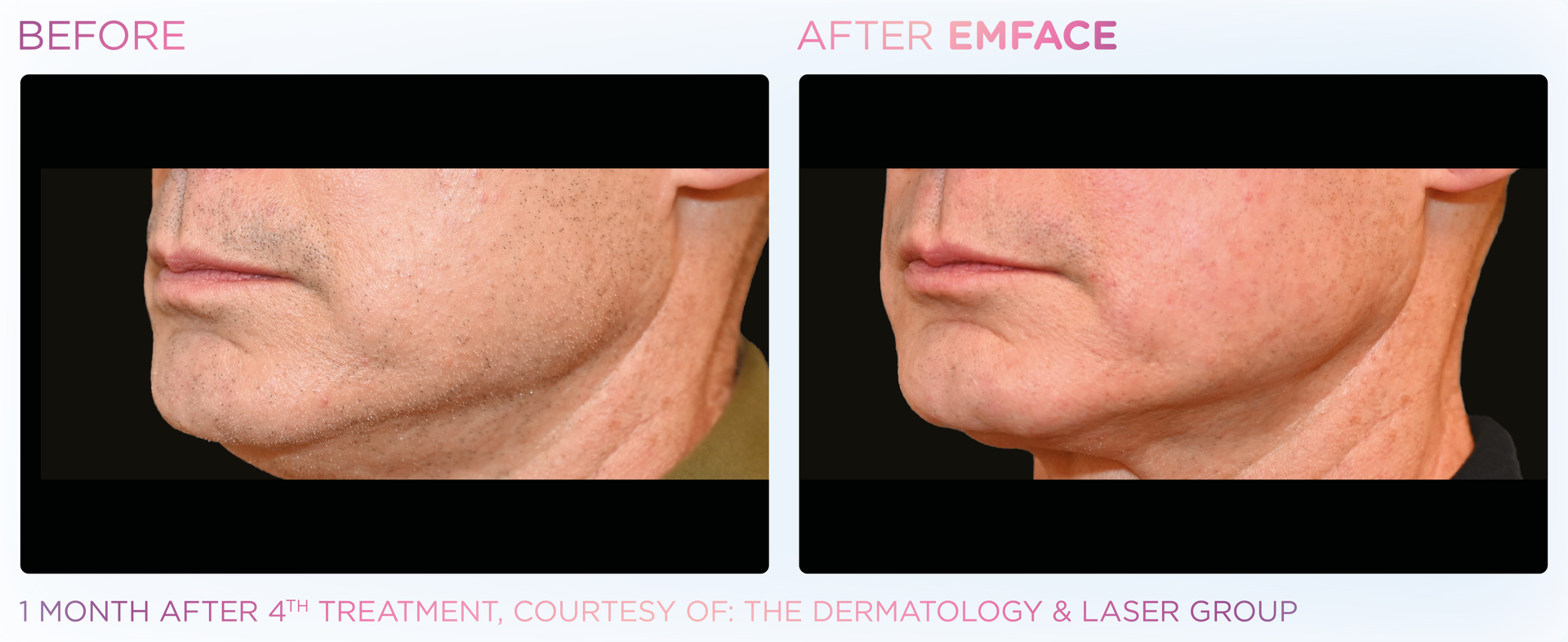 Achieve a refreshed complexion with Emface, the innovative, gentle procedure for reducing wrinkles and lifting the face.