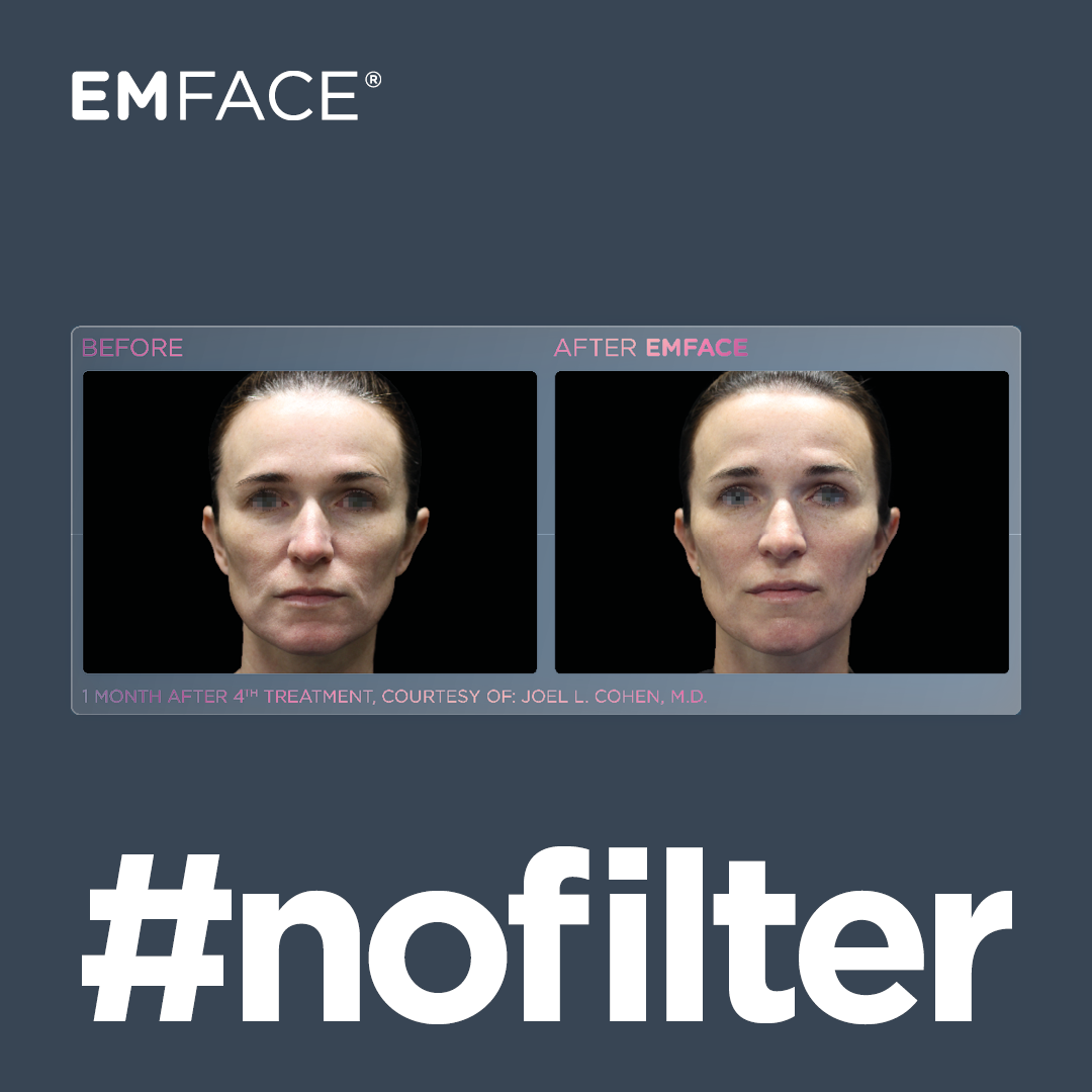 Achieve a youthful, refreshed complexion with Emface's gentle procedure, requiring no intense recovery or downtime.