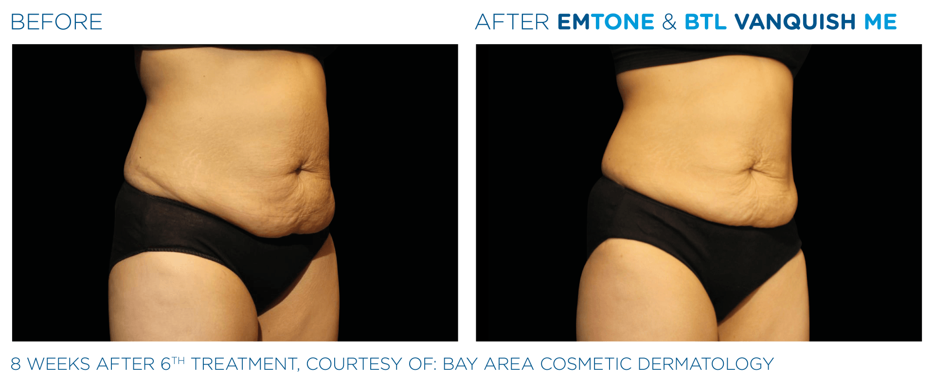 Discover the benefits of EmSculpt and EmSculpt NEO at Wrinkle and Weight in Westerville, OH. Get started today!