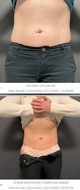 FDA-cleared Emsculpt Neo targets thighs, butt, arms, and calves, combining HIFEM with RF for superior fat reduction.
