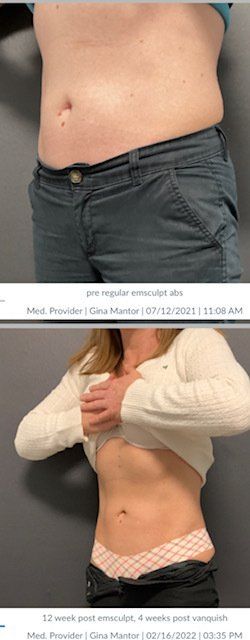 Experience fat burning and muscle building for thighs with Emsculpt and Emsculpt Neo at Dr. Mantor's clinic.