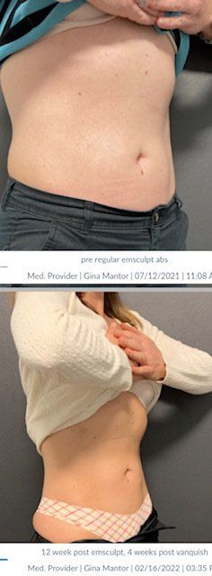 Achieve superior body sculpting with Emsculpt Neo, combining electromagnetic pulses and RF heat for effective fat loss.