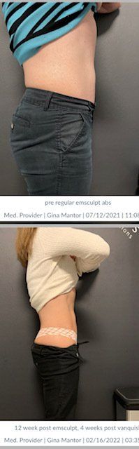 FDA-cleared Emsculpt Neo treats thighs, butt, arms, and calves with advanced HIFEM and RF technology for effective fat loss.