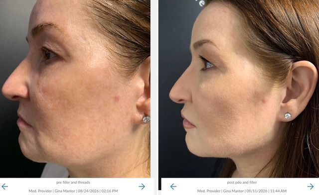Side-profile before-and-after photos showing a lifted cheek and more defined jawline after PDO threads and filler.