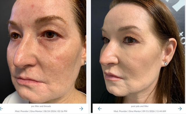 30 DEGREE ANGLE OF PATIENT RESULTS USING dR. mANTOR'S PDO LIFTING THREADS