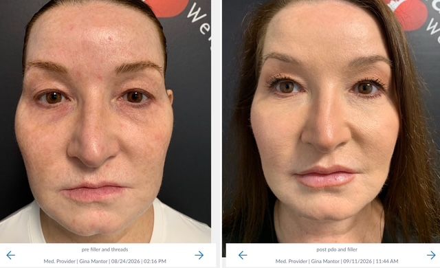 Front-view before-and-after photos showing refreshed facial contours after PDO thread lift and dermal filler treatment.
