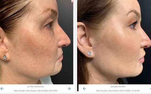 pdo thread results on patient's neck with Dr. Gina Mantor in Westerville, OH