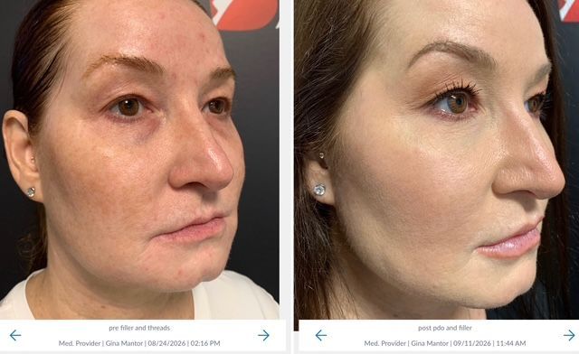 Side-view comparison showing enhanced facial contours and a smoother jawline following PDO threads and dermal filler.