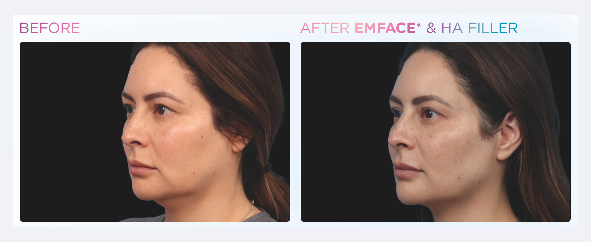 Emface treatment now at Dr. Mantor's Spa. No injections or needles. Banish eye bags and dark circles.