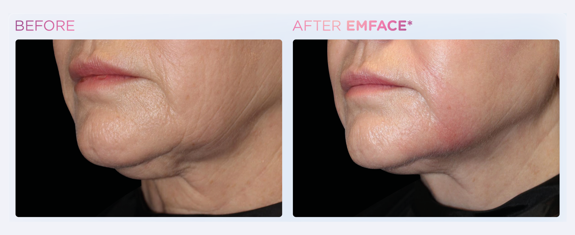 Lift & Tone Your Face Naturally with EMFACE®!