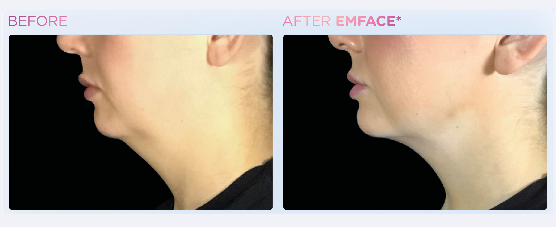 Lift, Tone, Transform with EMFACE! Book Now!